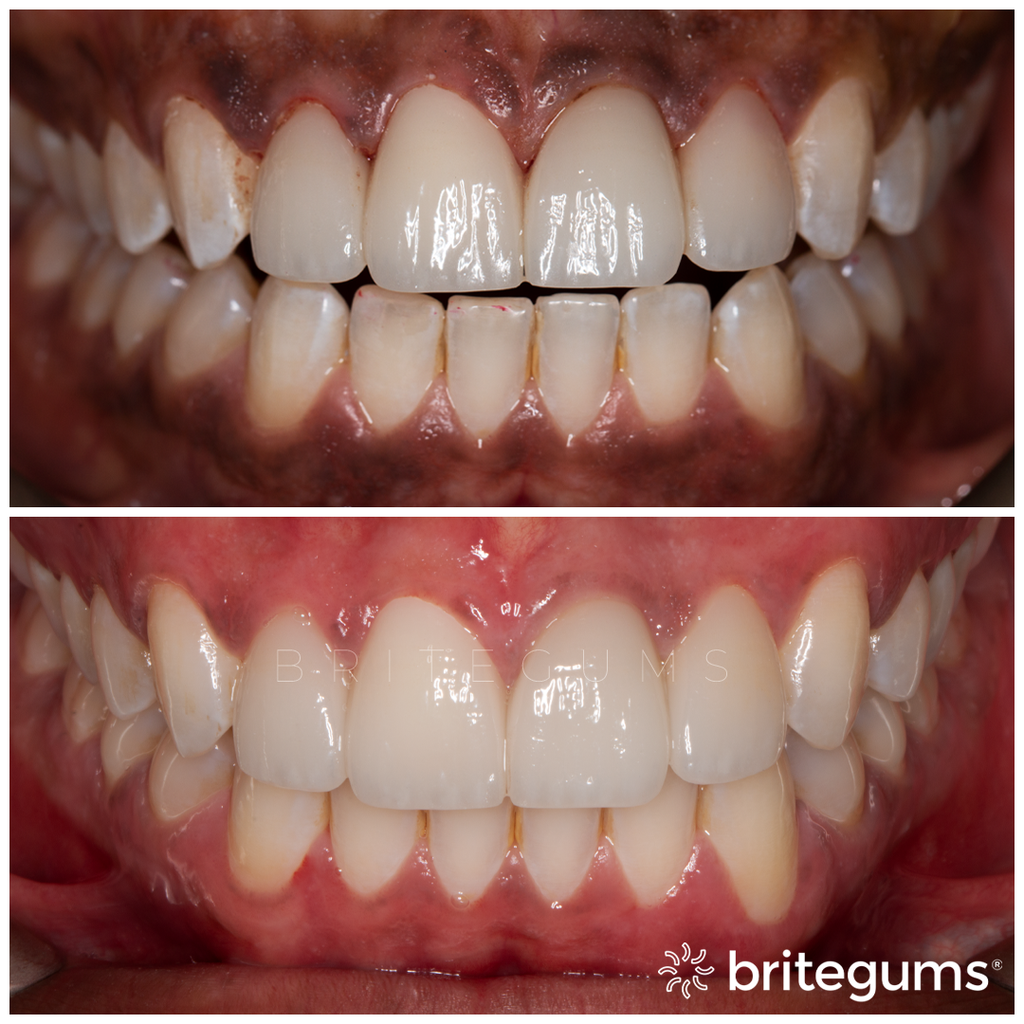 Britegums